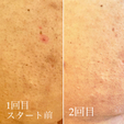 ボディの肌質改善コース